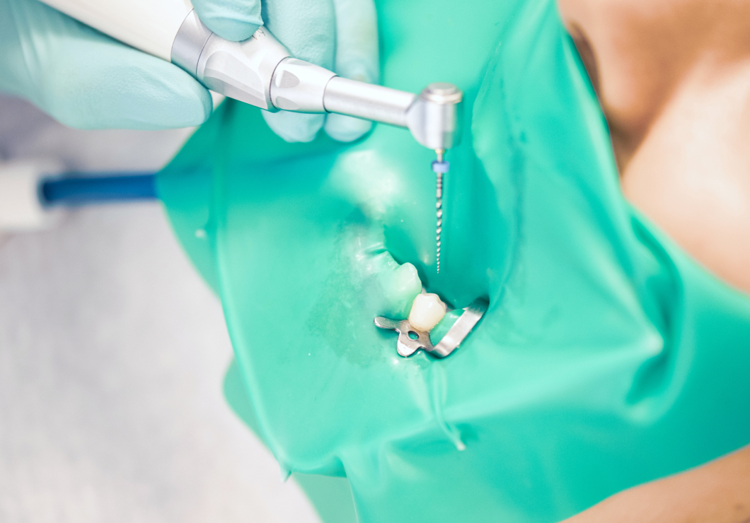 根管治療の精度を高める「ラバーダム防湿」