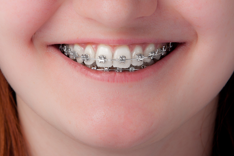 当院で取り扱う矯正方法